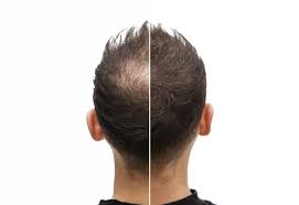 Das alter, der hormonstatus und die ethnische zugehörigkeit spielen eine rolle. Verhalten Nach Der Haartransplantation Health Travels