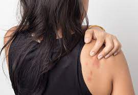 Why Am I Breaking Out In Hives When I M Stressed Cleveland Clinic