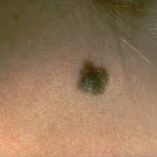 How your body handles treatment, whether it comes back, and other things play a role. Skin Cancer Rates Dropping In Northeast Rising In Other Parts Of Us