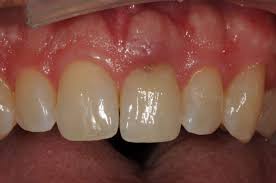 How do dentists fix cavities in the front teeth? Showcase Single Front Tooth Implant Dr Gennero