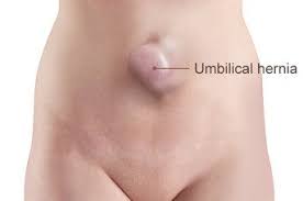 A hiatal hernia happens when part of the stomach or other abdominal tissue slides up into the middle of the chest through the hiatus. Umbilical Hernia Repair Melbourne Keyhole Umbilical Hernia Repair Melbourne