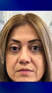 Finished up at a brilliant weekend in San Francisco, talking about the  latest insights into managing Thyroid Eye Disease with some of the most  brilliant minds in the industry. Loved being able