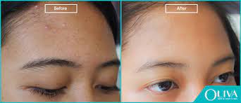 Use tea bags and refrigerate for several hours. Small Pimples On Forehead Causes Treatments And Results