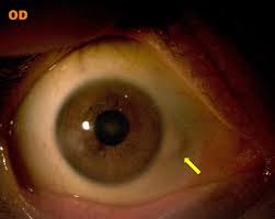 Image result for lesion sclera