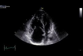 Plicní hypertenze znamená zvýšení tlaku v plicním krevním řečisti. Informace Pro Lekare Plicni Hypertenze