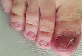 Image result for Onycholysis feet