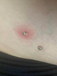 Infected Dermal Piercing Hip 7 Years Old Any Advice Alcohol Cleaning Piercing