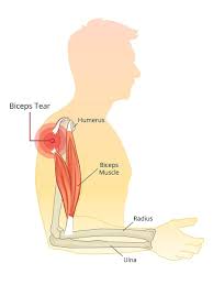 The distal biceps tendon may be bifurcated in about 20% or be completely separated in about 40% of individuals. Dr Terence Moopanar Biceps Tenodesis