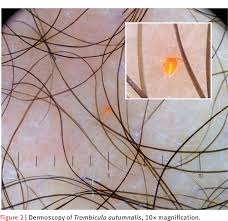 Image result for Trombicula autumnalis