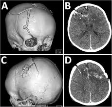 Medical abbreviations search, medical abbreviation, abbreviations, abbreviation. Open Wound Treatment For Gunshot To The Brain In Journal Of Neurosurgery Pediatrics Volume 10 Issue 1 2012