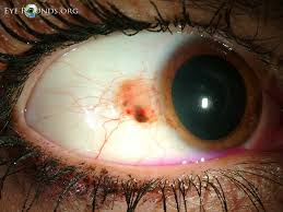 Image result for conjunctival melanoma
