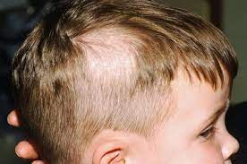 Salah satunya adalah seringnya pergantian shampoo dan juga rambut yang. Kok Rambut Si Kecil Rontok Nakita
