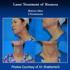 Southern institute of aesthetics is a dermatology practice located in west midtown atlanta. Southern Pines Aesthetics Laser Institute 14 Photos Medical Spas 6 Regional Dr West End Nc Phone Number Yelp