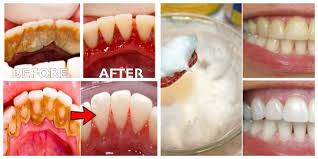 dental plaque homemade remes that