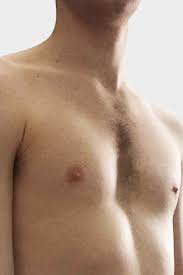 Image result for Pectus Excavatum