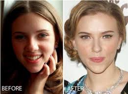 Jennifer Aniston Before And After Nose Job Nose Job Before After Scarlett Johansson N Celebrity Plastic Surgery Jennifer Aniston Plastic Surgery Nose Job