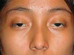 Hãy cùng tiếng anh 365 tìm hiểu những từ vựng tên các món ăn tiếng anh nhé! Sá»¥p Mi Máº¯t Co Thá»ƒ La Biá»ƒu Hiá»‡n Cá»§a Bá»‡nh NhÆ°á»£c CÆ¡