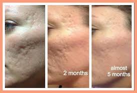 Pin On Acne Scars Pitted