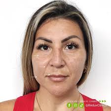 Los años te cayeron encima? DESLIZA Y MIRA EL CAMBIO ➡️➡️ Recupera la  juventud con un #RejuvenecimientoFacial en #ReduxClinica 😉 Regálate el  cambio que siempre soñaste Aprovecha las #promociones 🎁especiales por el