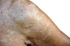 Maybe you would like to learn more about one of these? Erkrankungen Der Kopfhaut Es Kann Auch Ein Pilz Sein Pityriasis Versicol Pz Pharmazeutische Zeitung