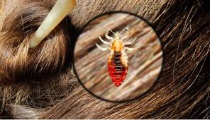Resultado de imagen de Eliminar los piojos
