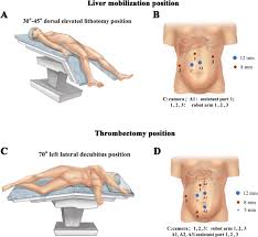 Maybe you would like to learn more about one of these? Robot Assisted Level Iii Iv Inferior Vena Cava Thrombectomy Initial Series With Step By Step Procedures And 1 Yr Outcomes European Urology