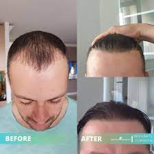 Hairavrasya Hairtransplant Sacekimi Trasplantecapilar Transplantacijakose زراعةالشعر 90 542 619 1524 Https Www Instagram Com Hairavrasya Https Www