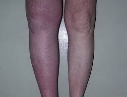 Tromboz Ven Lechenie Tromboza Ven I Konechnostej V Habarovske