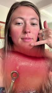 pimplepopperaddict #pimple#textractions#ingrownhairremoval#ingrown #i...