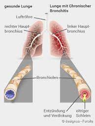 Copd, also known as chronic obstructive pulmonary disease, is a chronic lung condition in which the alveoli (air sacs) in your lungs no longer work properly, making it difficult to breathe. Copd Symptome Ursachen Folgen Therapie Netdoktor