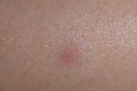 Image result for bedbug bites look like