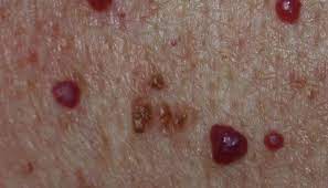 If they develop in areas where irritation may occur due to clothing, bleeding may occur. Cherry Angioma Symptoms Causes And Treatment
