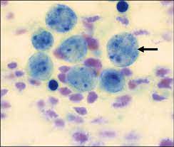 Mathew ludgate mbchb, dept of dermatology greenlane hospital auckland, new zealand, 2005. Bilateral Renal Metastases In A Case Of Merkel Cell Carcinoma Medhi S Purandare Nc Dua Sg Gujral S J Can Res Ther