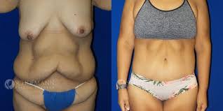 The ucla center for obesity and metabolic health program in los angeles, ca. After Weight Loss Surgery Before After Photos Dr Schoemann