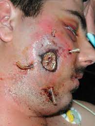 Mucormycosis is any fungal infection caused by fungi in the order mucorales. Mucormycosis Of The Head And Neck Report Of Five Cases With Different Presentations Sciencedirect