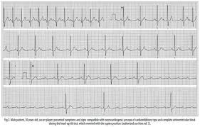 Image result for Head-Up Tilt-Table Testing