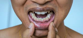 Image result for Gingivitis