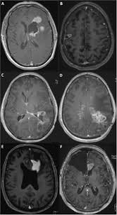 Cheap mechanical pencils, buy quality education & office supplies directly from china suppliers:japan uni kuru toga m3 450 0.3 mm mechanical pencil 1 piece enjoy ✓free shipping worldwide! Retrospective Analysis Of Radiological Recurrence Patterns In Glioblastoma Their Prognostic Value And Association To Postoperative Infarct Volume Scientific Reports