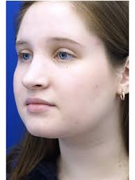 Reduction Dorsal Hump 3185