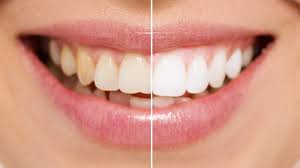 I have natural dark hair and on my ends is a few tones lighter from a previous bleaching that i did 2 years ago. Bleaching Fur Ihre Zahne Zahnarzte Am Stadtgarten