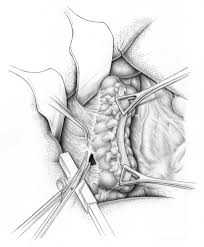 Ectopic ovary, colon sigmoideum mesenchymoma, intestinal mesenchymoma, abdominal pain, gists. Mobilisation Colon Sigmoideum I Eref Thieme