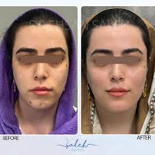 beautification before and one month after injection @dr.ehsan.saleh