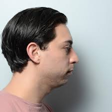 Chin implant with liposuction can bring amazing balance to the lower third  of the face. Swipe to see this transformation from multiple angles. Also  important to pick a size that appears natural. #