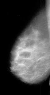 En france, la majorité des mammographies sont. 1 Mammographie D Un Sein Normal En Vue De Profil En Comparant Avec Le Download Scientific Diagram