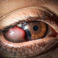 Image result for conjunctival melanoma