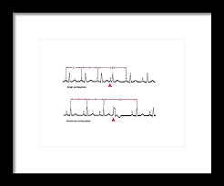 Image result for Extrasystole