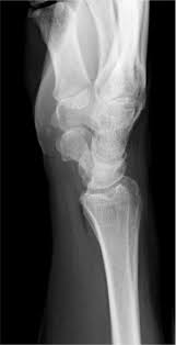 Image result for Wrist XRay