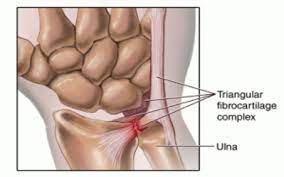 There are two types of tfcc tear: Tfcc Injury And Hand Therapy Hand Therapy Academy
