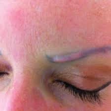 Sebuah keloid adalah jenis bekas luka mengangkat. Keloids After Laser Application For Removing The Tattoo Case Nr 5 Download Scientific Diagram