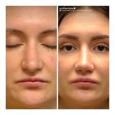 My experience with Dr Anthony Corrado. Afters are with my new doctor. :  r/PlasticSurgery